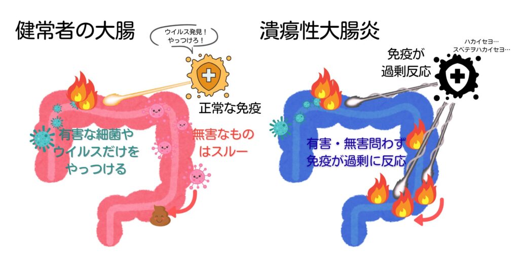 健常者の大腸と、免疫が過剰に反応してしまい炎症を引き起こす潰瘍性大腸炎患者の大腸の比較イラスト